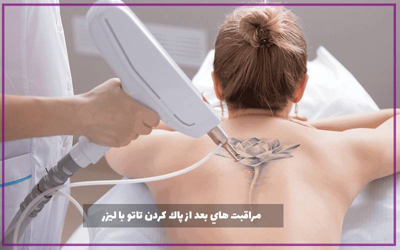مراقبت هاي بعد از پاك كردن تاتو با ليزر