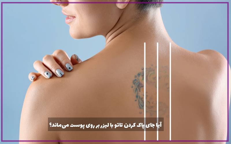 آیا جای پاک کردن تاتو با لیزر بر روی پوست می‌ماند؟