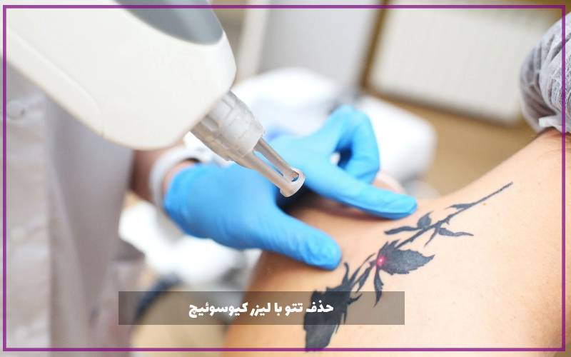 حذف تتو با لیزر کیوسوئیچ