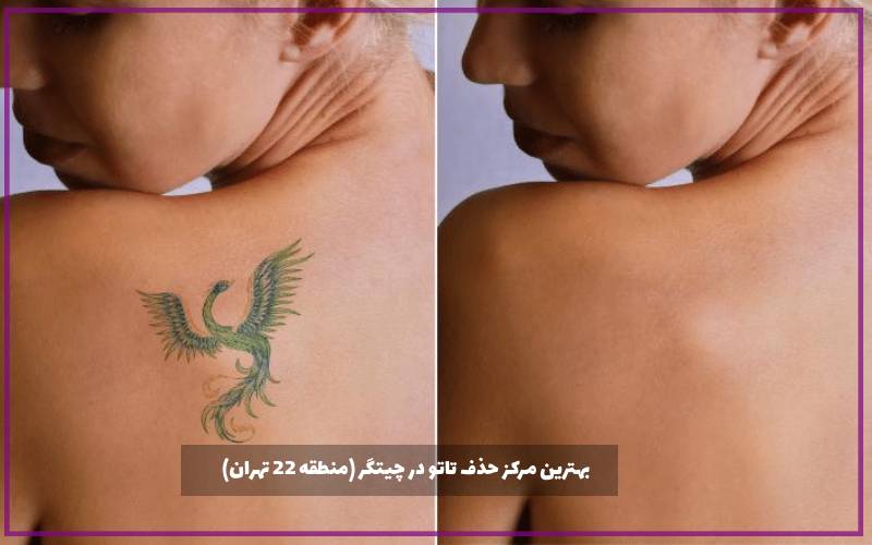 بهترین مرکز حذف تاتو در چیتگر (منطقه 22 تهران)