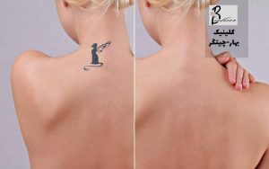 بهترين روش پاك كردن تاتو