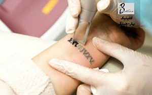 تفاوت حذف تاتو با کیوسوئیچ و پیکوشور