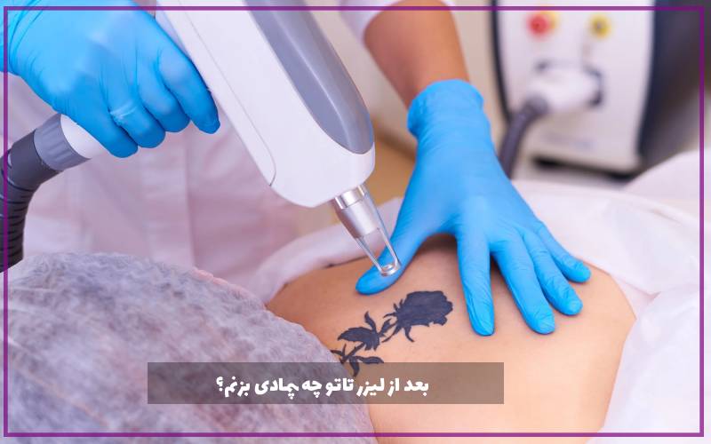 بعد از لیزر تاتو چه پمادی بزنم؟