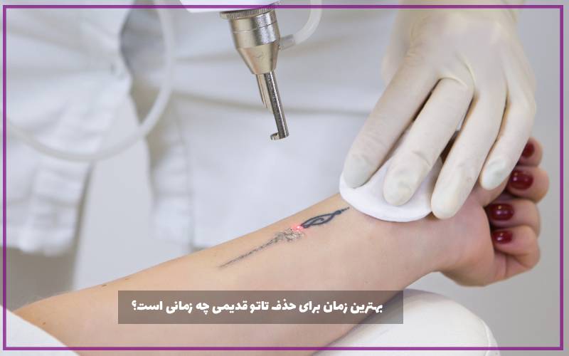 بهترین زمان برای حذف تاتو قدیمی چه زمانی است؟