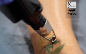 بهترین زمان برای حذف تاتو قدیمی چه زمانی است؟