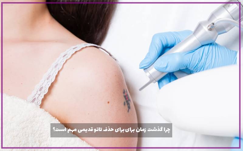 چرا گذشت زمان برای برای حذف تاتو قدیمی مهم است؟