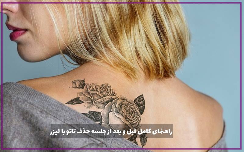 راهنمای کامل قبل و بعد از جلسه حذف تاتو با لیزر