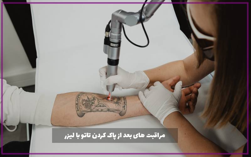 مراقبت های بعد از پاک کردن تاتو با لیزر