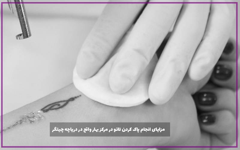 مزایای انجام پاک کردن تاتو در مرکز بهار واقع در دریاچه چیتگر