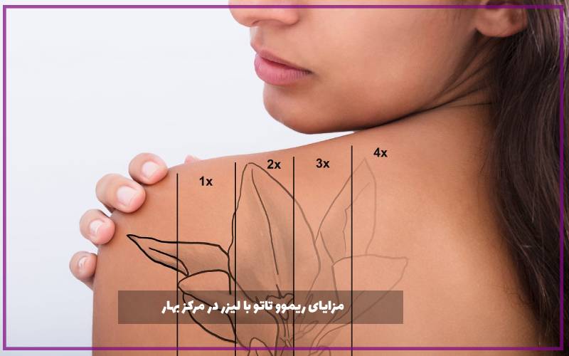 مزایای ریموو تاتو با لیزر در مرکز بهار