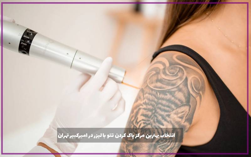 انتخاب بهترین مرکز پاک کردن تتو با لیزر در امیرکبیر تهران