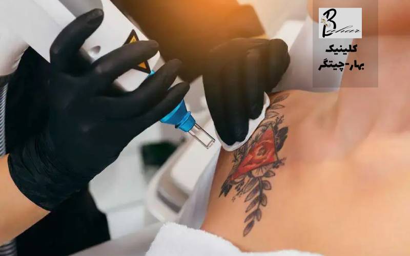 راهنمای کامل قبل و بعد از جلسه حذف تاتو