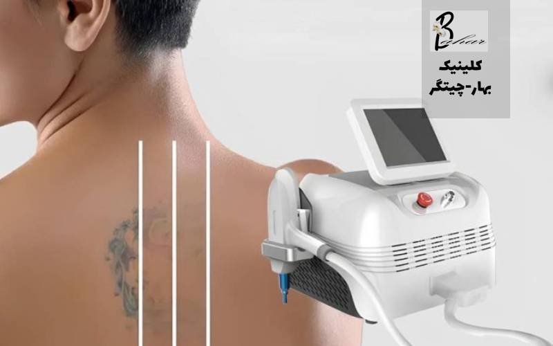 پاک کردن تاتو با لیزر چقدر زمان می برد و چند جلسه نیاز دارد؟