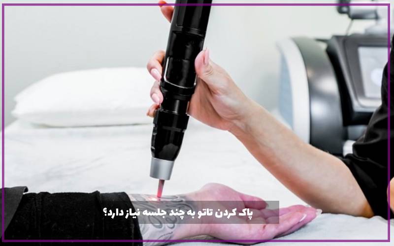 پاک کردن تاتو به چند جلسه نیاز دارد؟