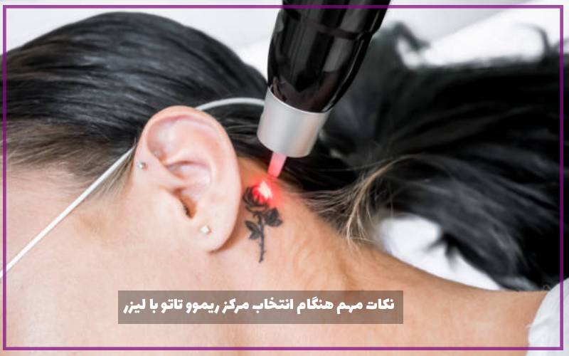 نکات مهم هنگام انتخاب مرکز ریموو تاتو با لیزر