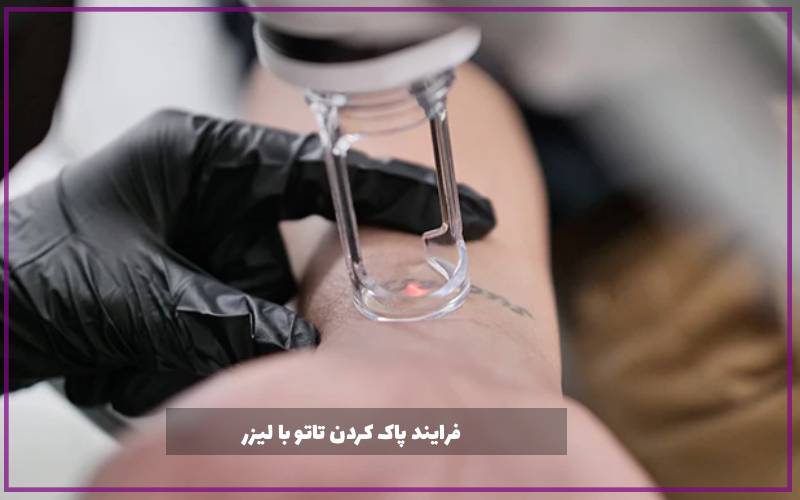 فرایند پاک کردن تاتو با لیزر