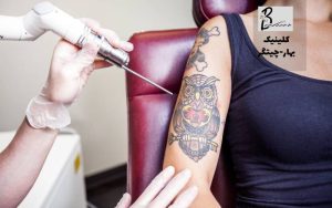 بهترین مرکز حذف تاتو با لیزر در امیرکبیر تهران