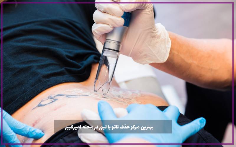 بهترین مرکز حذف تاتو با لیزر در محله امیرکبیر