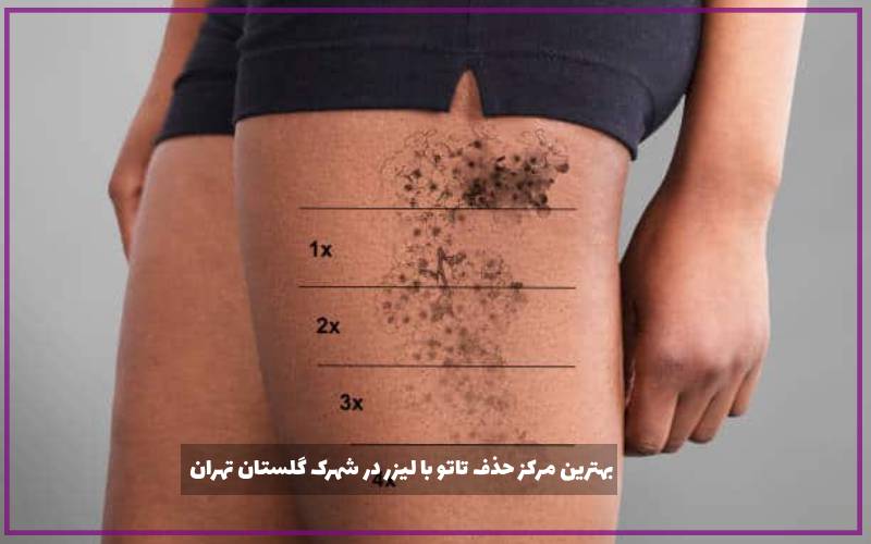 بهترین مرکز حذف تاتو با لیزر در شهرک گلستان تهران