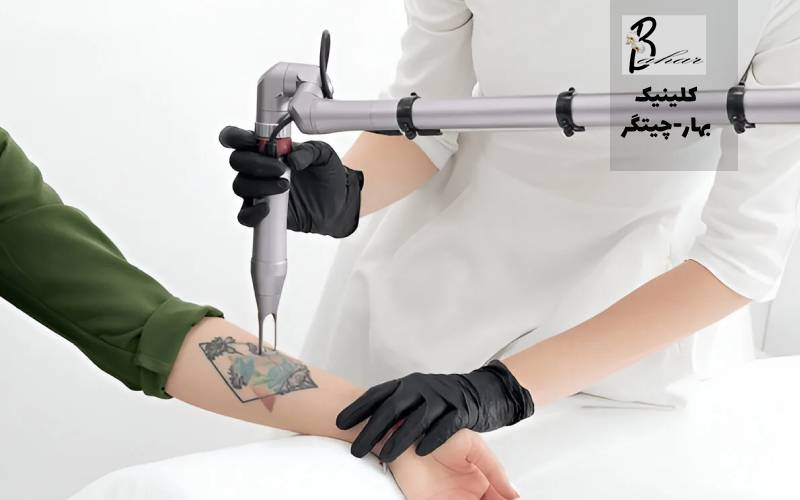 بهترین مرکز حذف تاتو با لیزر در شهرک گلستان تهران