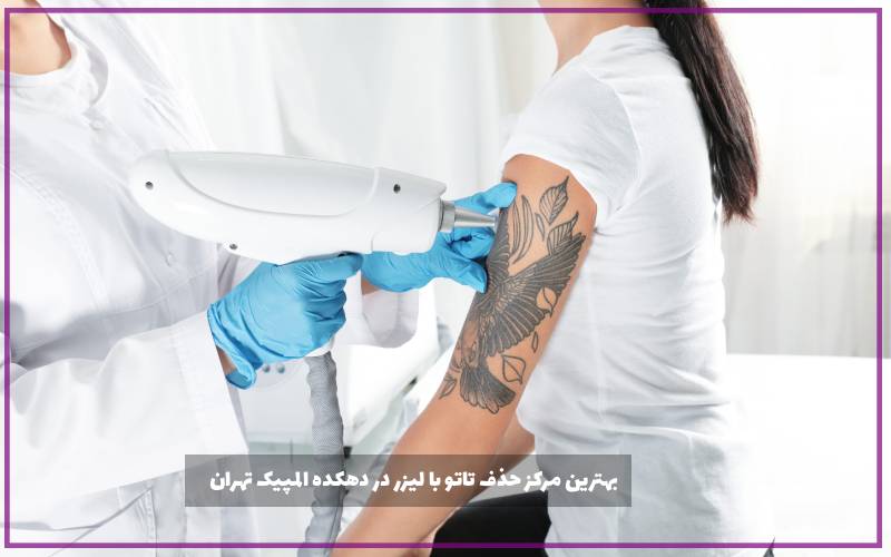 بهترین مرکز حذف تاتو با لیزر در دهکده المپیک تهران