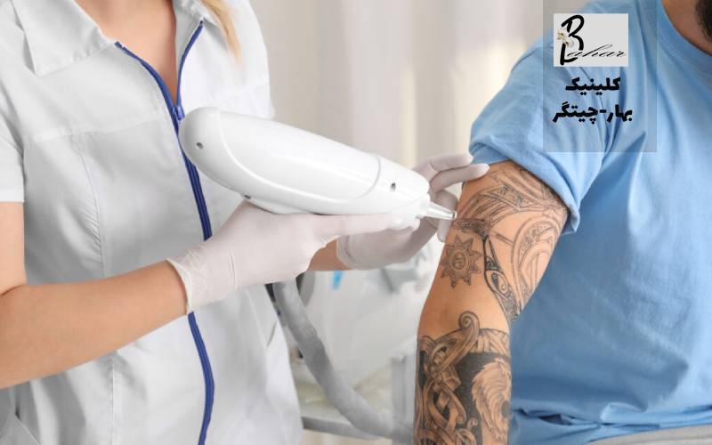 بهترین مرکز حذف تاتو با لیزر در دهکده المپیک تهران