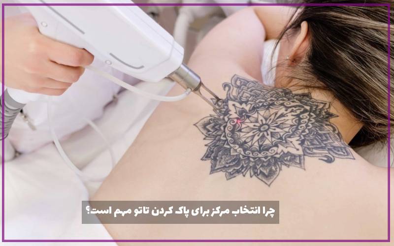 چرا انتخاب مرکز برای پاک کردن تاتو مهم است؟