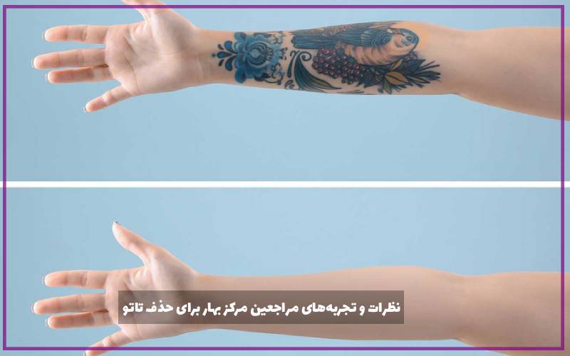 نظرات و تجربه‌های مراجعین مرکز بهار برای حذف تاتو