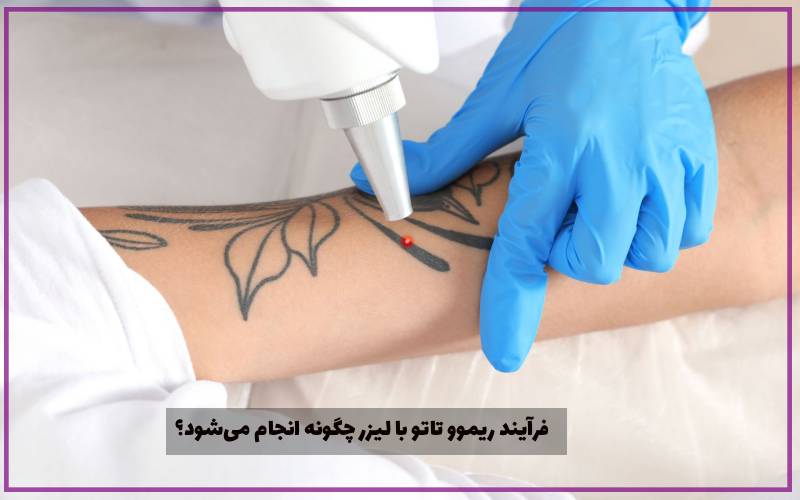 فرآیند ریموو تاتو با لیزر چگونه انجام می‌شود؟