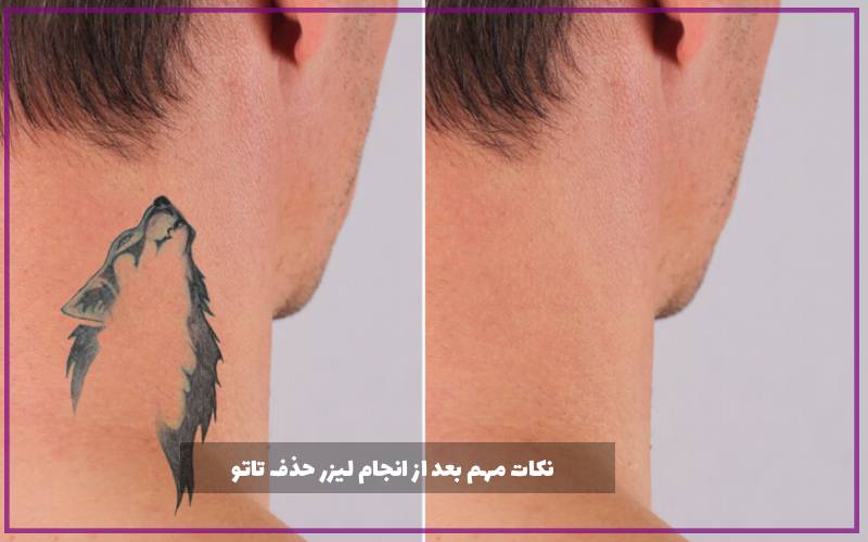 نکات مهم بعد از انجام لیزر حذف تاتو