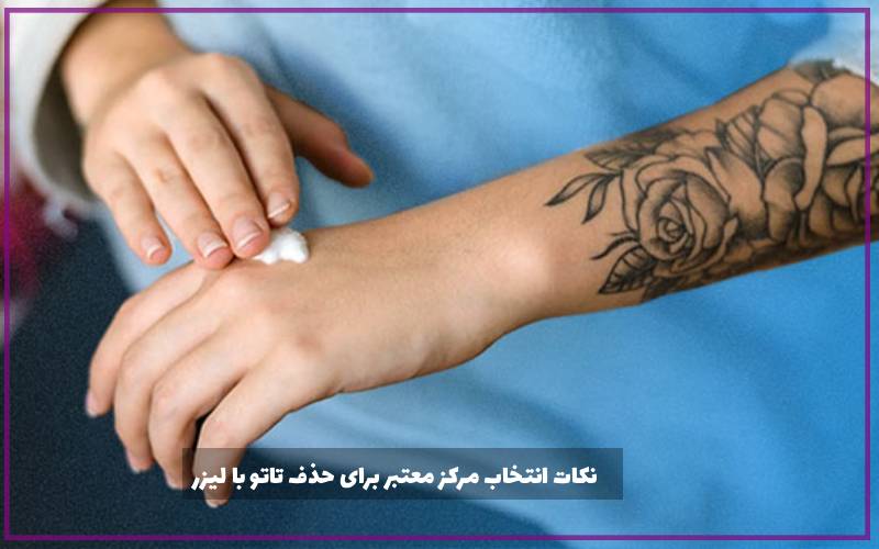 نکات مهم در انتخاب مرکز معتبر برای حذف تاتو با لیزر
