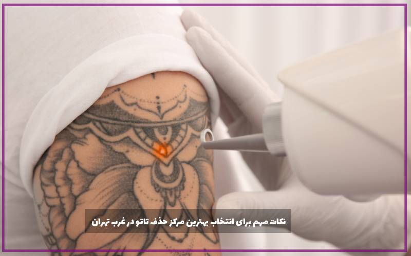 نکات مهم برای انتخاب بهترین مرکز حذف تاتو در غرب تهران