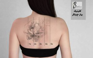 مرکز حذف تاتو با لیزر در شهرک چشمه