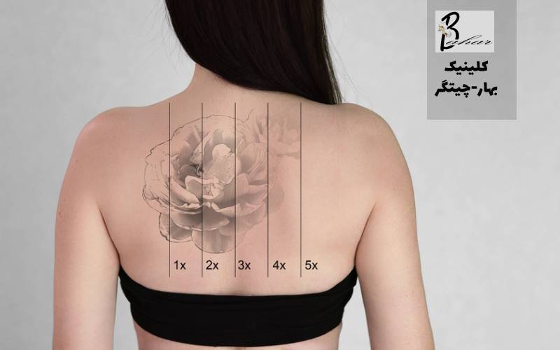 مرکز حذف تاتو با لیزر در شهرک چشمه