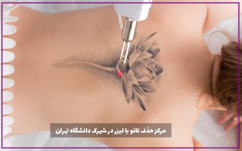 مرکز حذف تاتو با لیزر در شهرک دانشگاه تهران