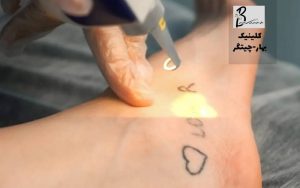 پاک کردن تاتو با لیزر در وردآورد