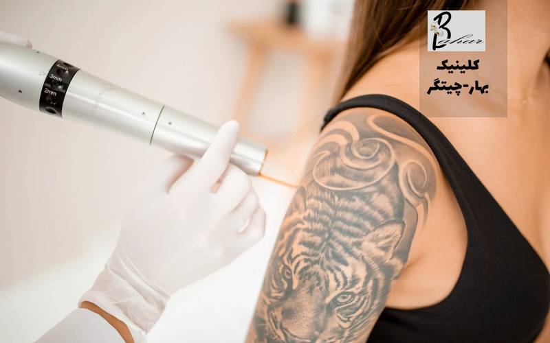 پاک کردن تاتو با لیزر در شهرک ویلاشهر تهران