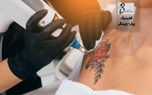 پاک کردن تاتو با لیزر در محله آزاد شهر تهران