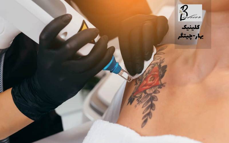 پاک کردن تاتو با لیزر در محله آزاد شهر تهران