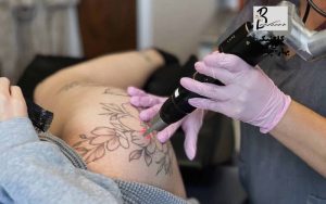 حذف تاتو با لیزر در شهرک دانشگاه