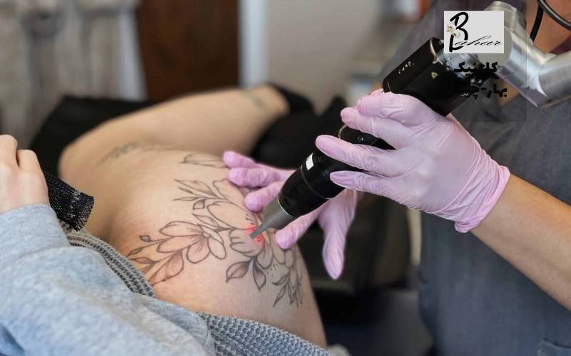 حذف تاتو با لیزر در شهرک دانشگاه