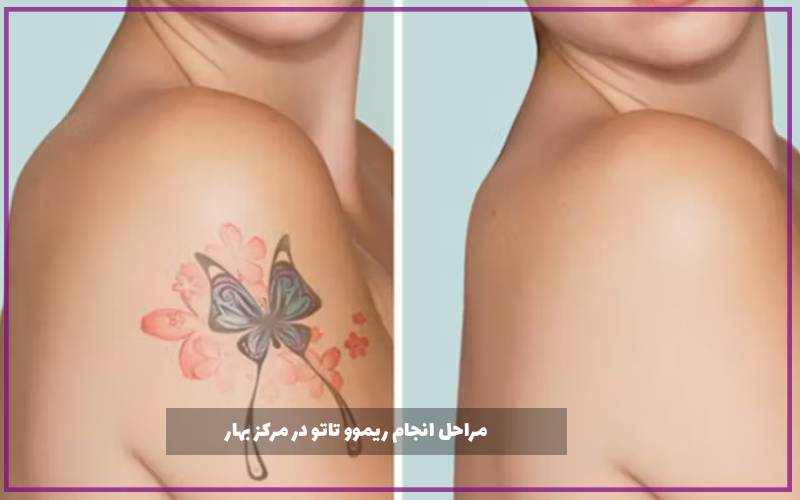 مراحل انجام ریموو تاتو در مرکز بهار