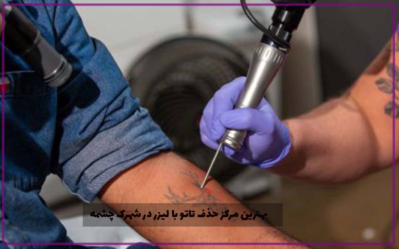 بهترین مرکز حذف تاتو با لیزر در شهرک چشمه