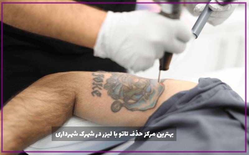 بهترین مرکز حذف تاتو با لیزر در شهرک شهرداری