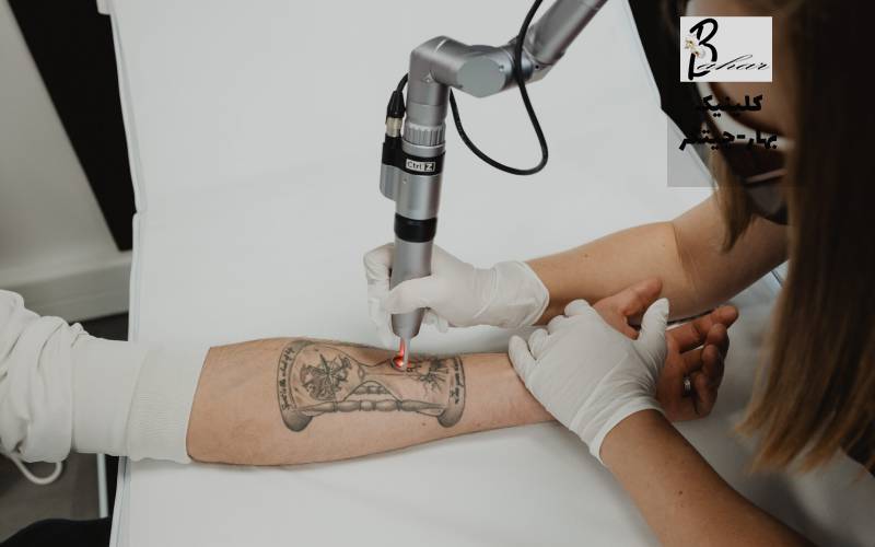 بهترین مرکز حذف تاتو با لیزر در شهرک شهرداری