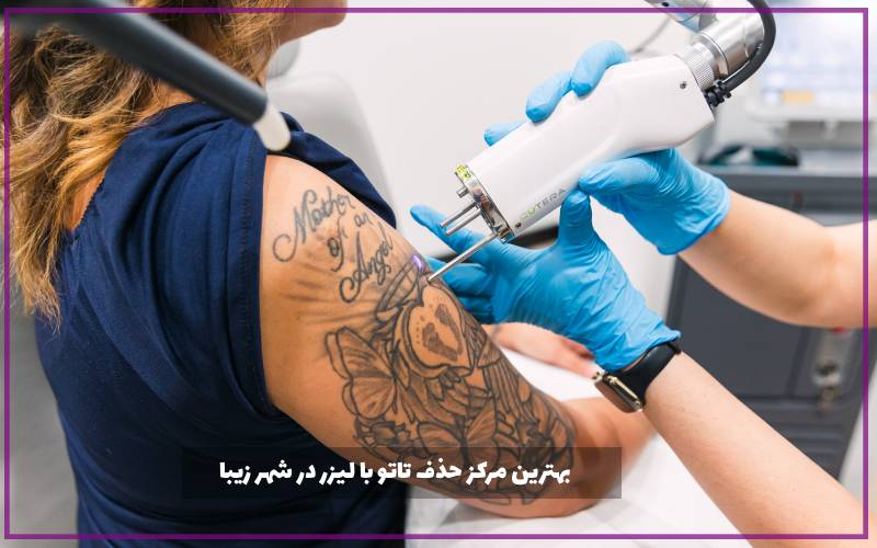 بهترین مرکز حذف تاتو با لیزر در شهر زیبا