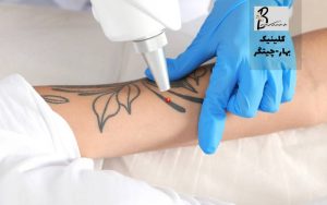بهترین مرکز حذف تاتو با لیزر در شهر زیبا