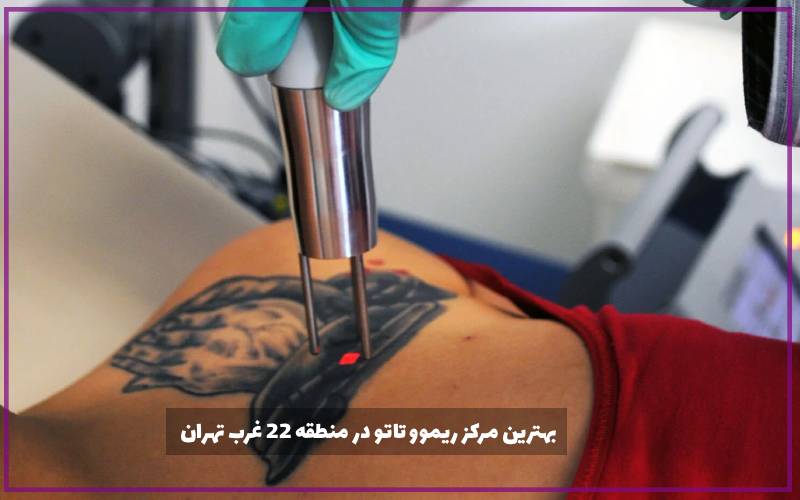 بهترین مرکز ریموو تاتو در منطقه 22 غرب تهران