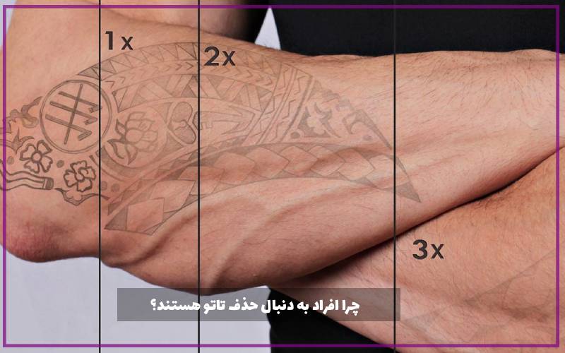 چرا افراد به دنبال حذف تاتو هستند؟