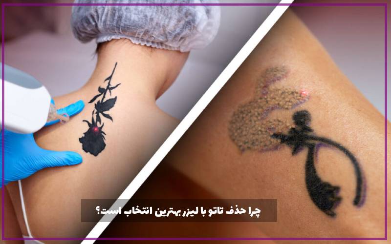 چرا حذف تاتو با لیزر بهترین انتخاب است؟
